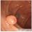 大腸ポリープの症例写真（内視鏡検査）
