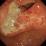 胃がんの写真