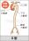 大動脈解離の分類(ドゥベ-キー分類Ⅱ)のイラスト