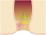 痔核のイラスト