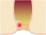痔核のイラスト