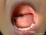 ヘルパンギーナ感染症の写真