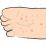 足の裏の水疱のイラスト