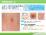 溶連菌感染症とはの説明スライド