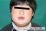 おたふくかぜによる耳下腺炎の写真