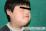 おたふくかぜによる耳下腺炎の写真