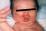 とびひの発疹の写真