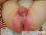 おむつ皮膚炎によるかぶれの写真