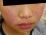 薬疹の写真