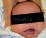 乳児脂漏性皮膚炎の写真