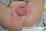 乳児寄生菌性紅斑の写真