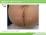 肛門スキンタグ（症例写真）（１歳１ヶ月の女児）の説明スライド