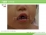 川崎病（症例写真）（１歳５ヶ月の女児）の説明スライド
