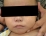 突発性発疹による発疹の写真