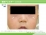 食物アレルギー（症例写真）の説明スライド
