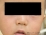 食物アレルギーによる発疹の写真