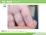 手指２度熱傷（症例写真）（10ヶ月男児）の説明スライド