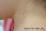 特発性血小板減少性紫斑病　頚部の写真
