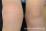 血管性紫斑病 膝関節周囲の膨張と紫斑の写真