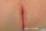 溶連菌による肛門周囲炎の写真